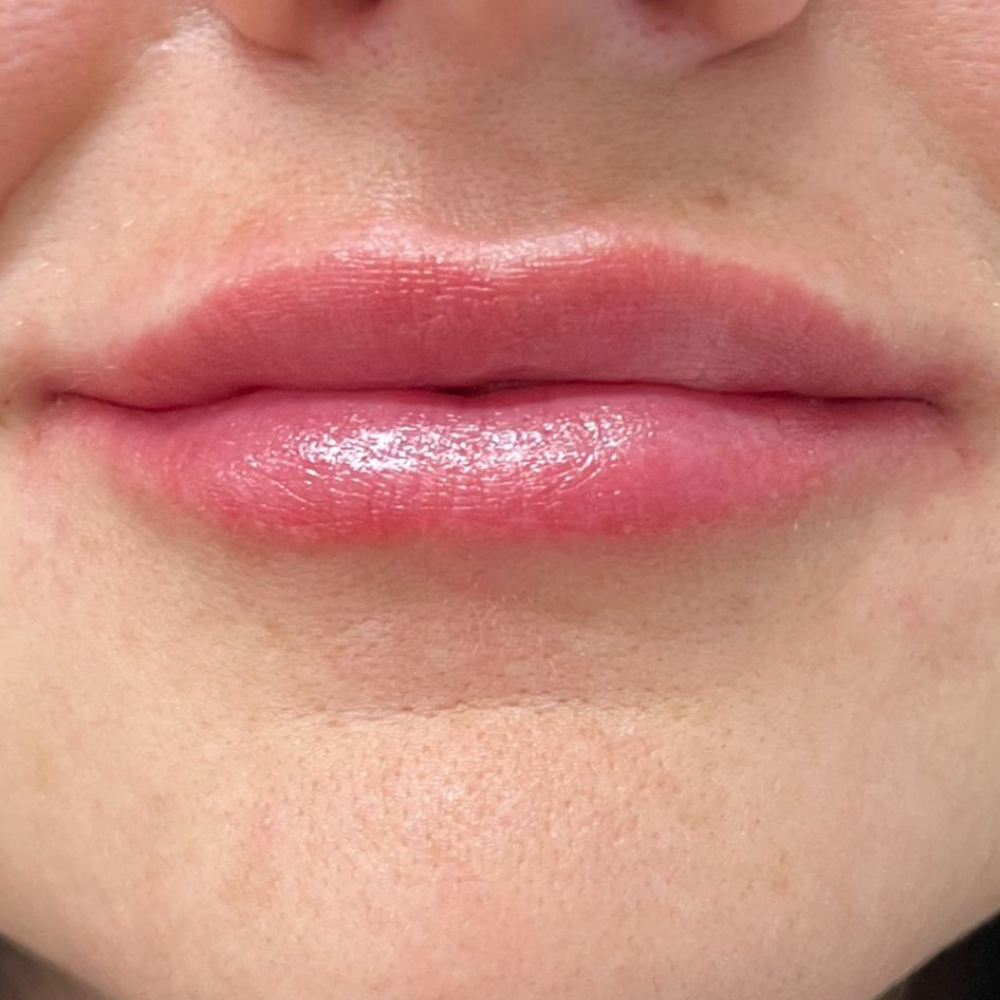 Lippen nach der Behandlung