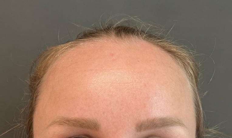 Stirn nach der Behandlung