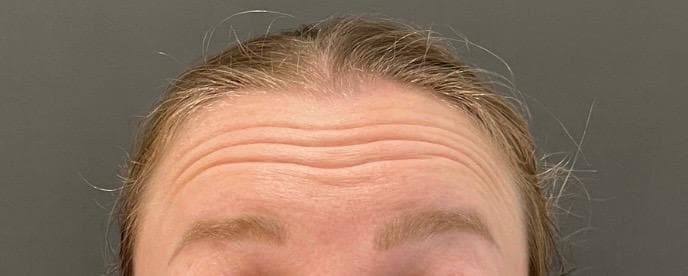 Stirn vor der Behandlung