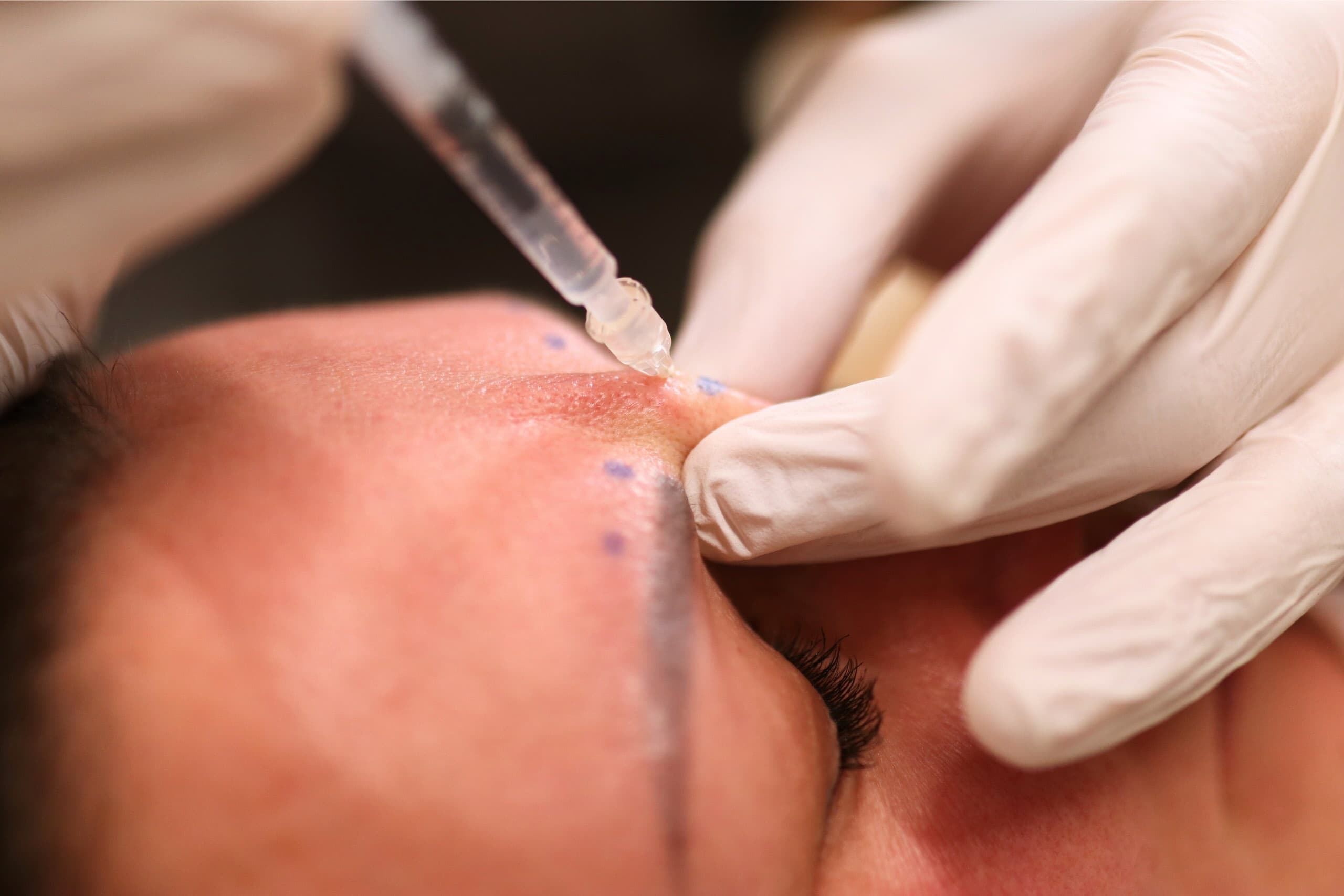 Präzise ästhetische Behandlung