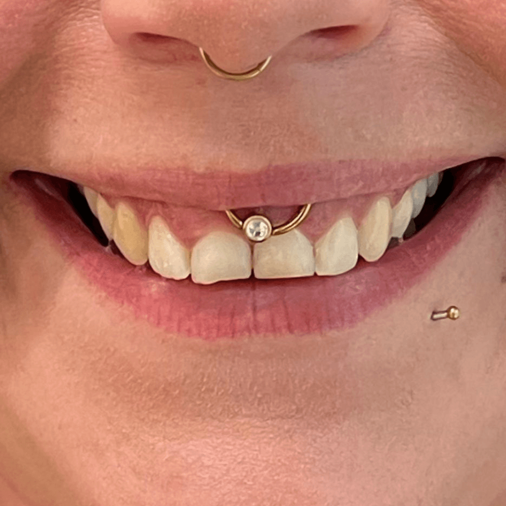 Gummy Smile nach der Behandlung