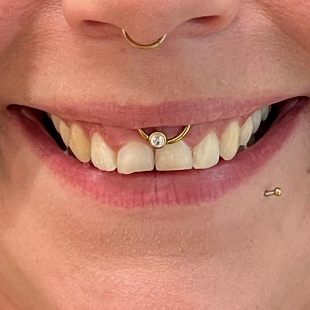 Gummy Smile nach der Behandlung