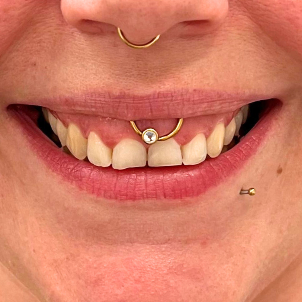 Gummy Smile vor der Behandlung